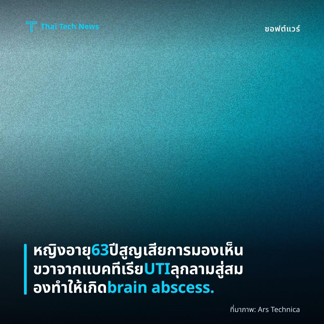 หญิงอายุ 63 ปีสูญเสียการมองเห็นขวา จากแบคทีเรีย UTI ลุกลามสู่สมองทำให้เกิด brain abscess.
