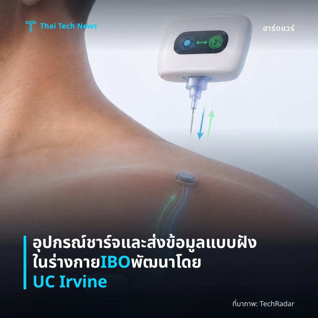 อุปกรณ์ชาร์จและส่งข้อมูลแบบฝังในร่างกาย IBO พัฒนาโดย UC Irvine